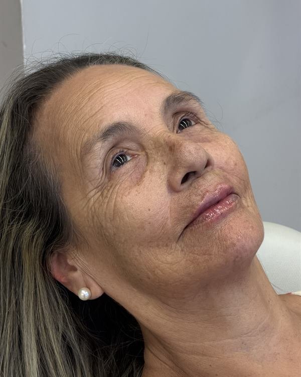Mesma paciente em três quartos, logo após o procedimento
