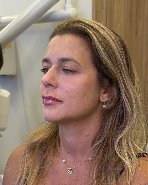 Mesma paciente em três quartos, logo após o procedimento