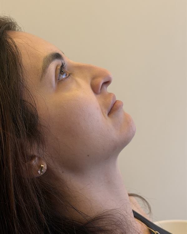 Paciente de perfil, antes do procedimento