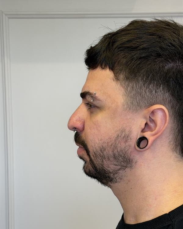 Paciente de perfil, antes do procedimento