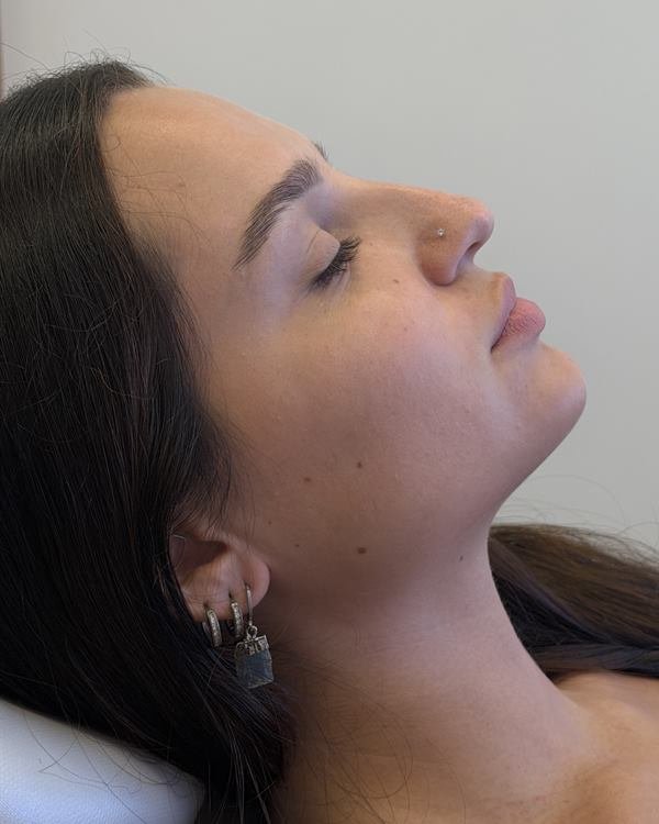 Paciente de perfil, antes do procedimento