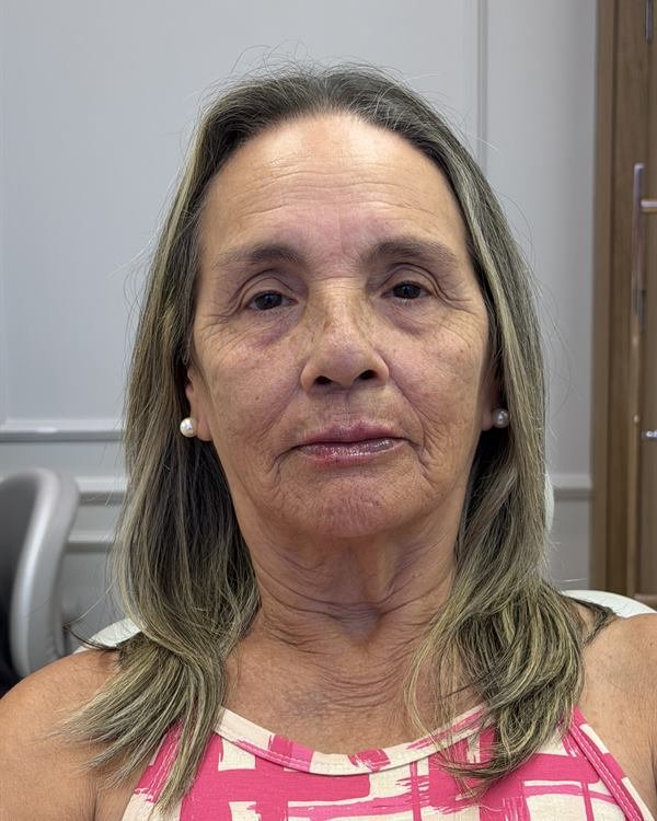 Mesma paciente de frente, logo após o procedimento